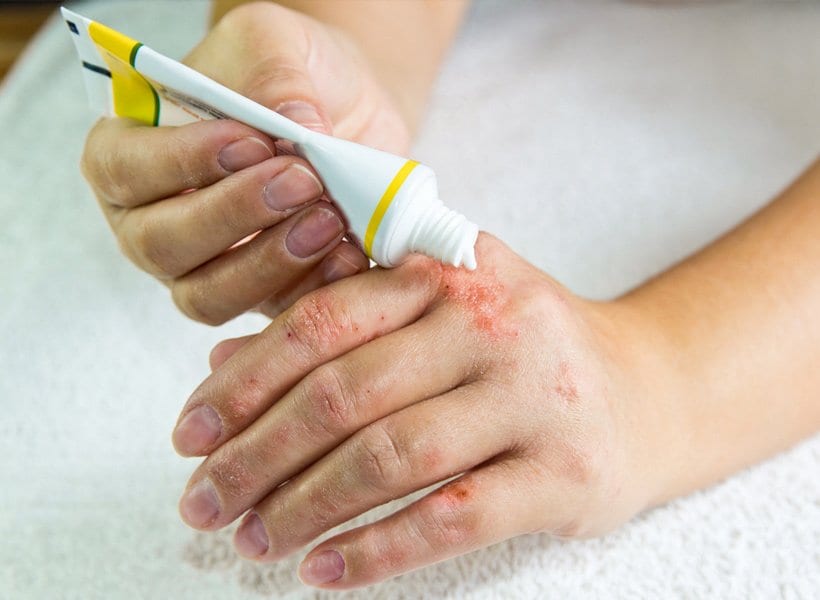 Ointment being rubbed on hands with a rash