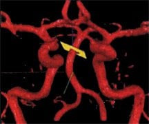 Nova Flow Blood Vessels